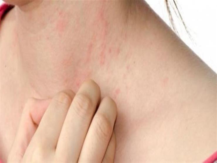 هذه الأعراض الجلدية قد تنذر بالإصابة بكورونا
