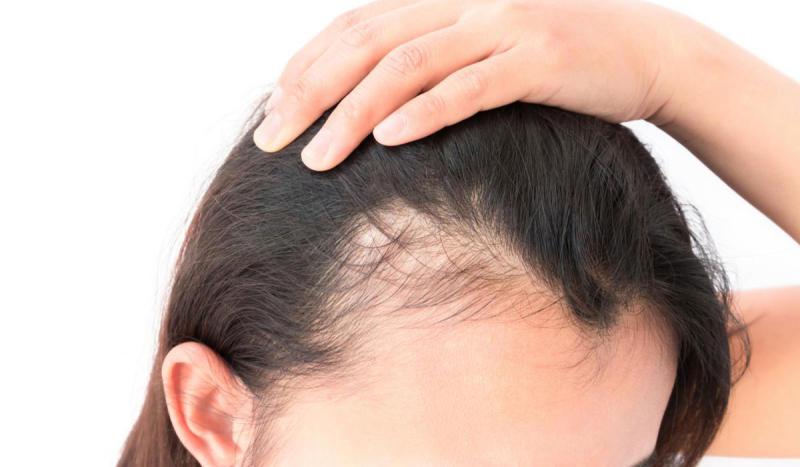 كيفية علاج فراغات الشعر لمنع الإحراج!