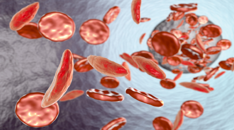 5 علامات جسدية منبهة لفقر الدم